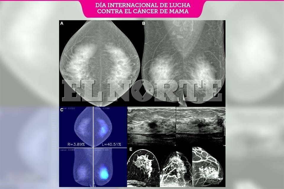 Brinda IA esperanza contra el cáncer de mama